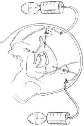 Gambar 2.7 Pemasangan EVD  dari bagian posterior dan frontal. (Dikutip dari: James Tait Goodrich