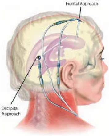 Gambar 2.3. Komponen CSF shunts. (Dikutip dari : Cathy C. Cartwright and Donna C. Wallace