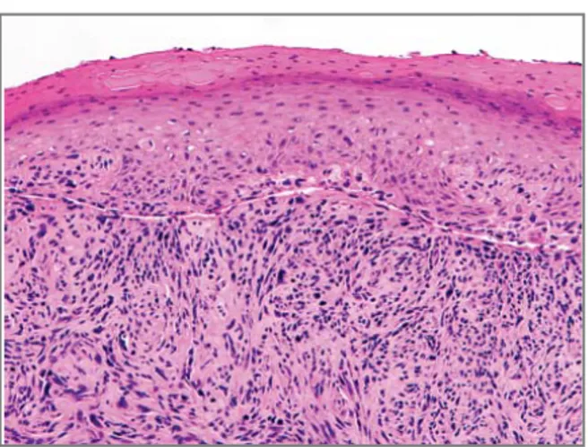 Gambar 2.6. Spindle-cell squamous cell carcinoma. 18 