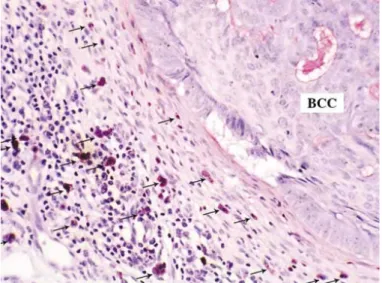 Gambar 2.12. Akumulasi sel mast pada perifer basal cell carcinoma ditunjukkan oleh panah  (Pewarnaan toluidine blue, 400x)