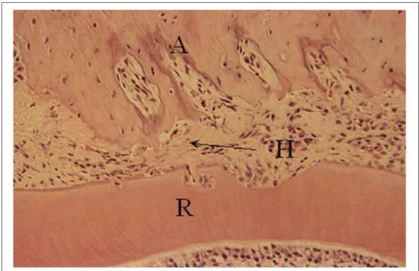 Gambar  2.5 Gambaran Photomicrograph menunjukkan kelompok cluster dari epitel rest  (tanda panah)  pada sisi penekanan dari ligamen periodontal didekat akar pada kelompok  experimental 18 jam; H; Hyalinisasi (Meikle M.C, 2006)