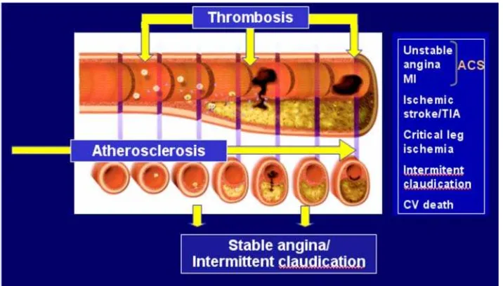 Gambar 2.1 Perjalanan Proses Aterosklerosis pada Plak Aterosklerosis 