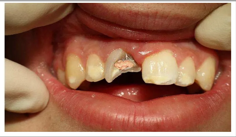 Gambar 3. Fraktur gigi pasca perawatan endodontik.20  