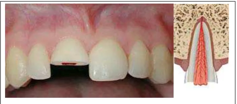 Gambar 5. Fraktur terbatas pada email dan dentin dengan hilangnya struktur gigi, tapi tidak melibatkan pulpa.23,24 