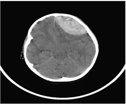 Fig. 5. Noncontrast head CT showing a large mixed-density EDH located in the left frontalhemisphere.