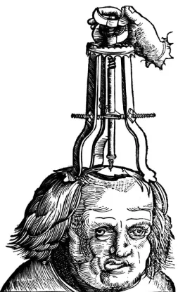 Fig. 1. Von Gersdorﬀ. Feldtbuch der Wundartzney. Strossberg, J Schott, 1517. Illustrationshowing the method of elevating depressed skull fractures