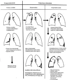 Gambar 6: Patogenesis TB primer dan TB post primer secara gambaran radiologi.20 