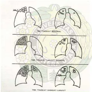 Gambar 7: pembagian luas lesi foto thorax menurut American Thoracic Society.24 