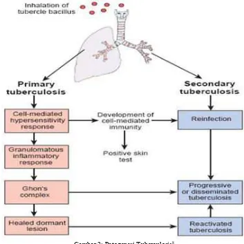 Gambar 2: Patogenesi Tuberculosis8  