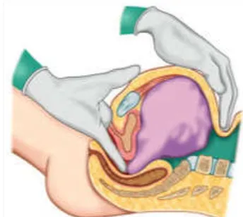 Gambar 2.3 Pemeriksaan bimanual uterus 