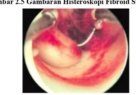 Gambar 2.5 Gambaran Histeroskopi Fibroid Submukosa 