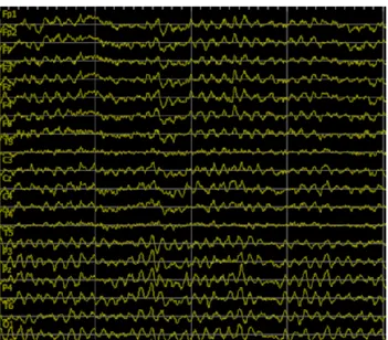 Gambar 3.1A. Contoh data sinyal EEG pada konsentrasi rendah 
