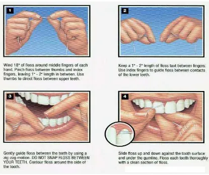 Gambar 2.3. Cara pemakaian benang gigi (dental floss) 
