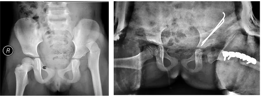 Gambar Radiologi Preoperatif dan Post Operatif Tindakan Reduksi Terbuka dengan    Pemendekan Tulang Femoral Dan Pelvic Osteotomi