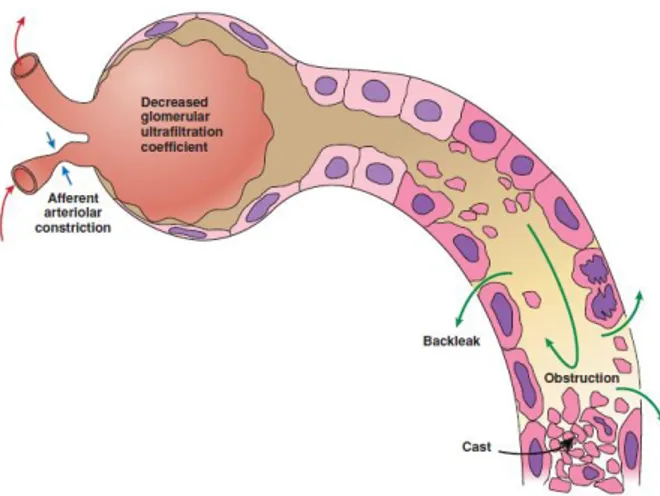 Gambar 3. Patogenesis gagal ginjal akut akibat  jejas tubular akut (ATI) 