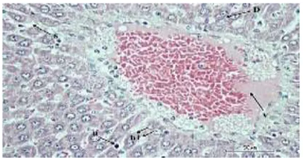 Gambar        7.  Penampang  Melintang  Histologi  Hati  dengan  Pemberian  Parasetamol  180  mg/200  g  BB,  D  (degenerasi  sel),  K  (karioreksi),  H1  (hepatosit  menyimpang)