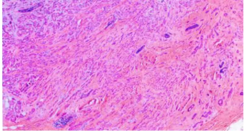 Gambar  2.6.  Mixed  IBC  NST  with  special  subtype.  IBC  NST  (upper left) mixed with invasive lobular carcinoma (lower left)