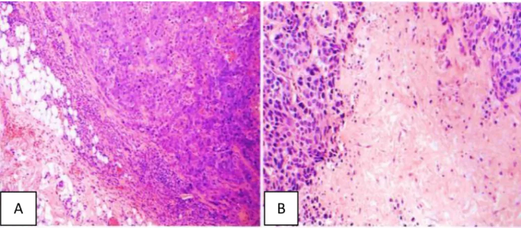 Gambar 2.7. IBC NST with medullary pattern. A. High-grade breast cancer with features  of IBC NST with medullary pattern