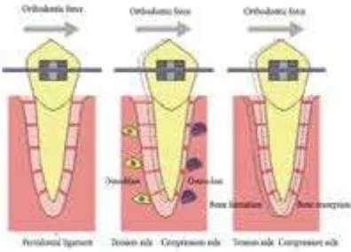 Gambar 1 Mekanisme pergerakan gigi pada perawatan 