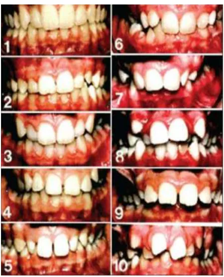 Tabel 2. Jenis gigi berjejal rahang atas pada anak umur 7-12 di RSGM