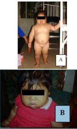 Gambar 2.5 Bayi dengan hipotiroid kongenital.(Gambar A) didapatkan hernia umbilikalis,hipotoni, letargi