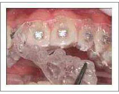 Gambar 25. A. Penggunaan adhesive light cure, B. Light curing 35