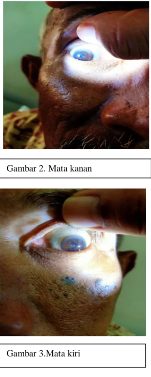 Gambar 2. Mata kanan