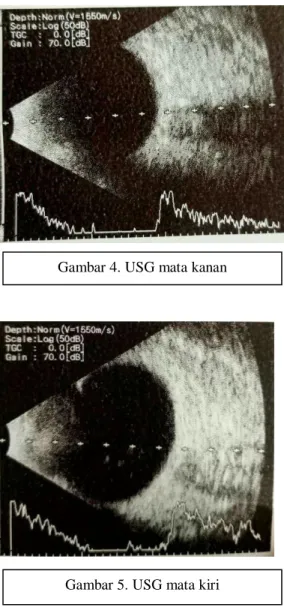 Gambar 5. USG mata kiri 
