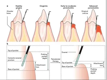 Gambar 2. a. Skema gingiva sehat, gingivitis, periodontitis   awal-sedang, dan periodontitis parah