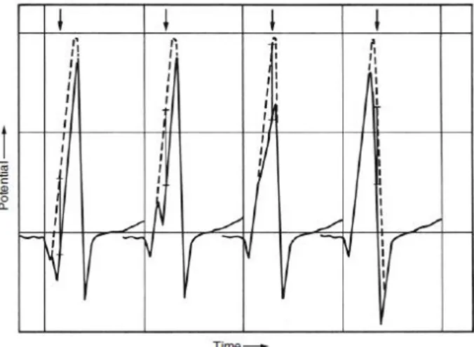 Gambar  2.6  Gambaran  EKG  lead  V6  pada  simulasi  komputer  infark  miokard,  dengan meletakkan infark ukuran 15 x 7 mm pada lokasi yang berbeda mulai dari  inferior  sampai  posterolateral  miokard