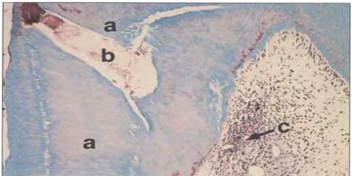 Gambar 3.   Tunnel Defect (b) pada dentin reparatif (a) yang  terbentuk oleh kalsium hidroksida (Rutherford,  2007) 