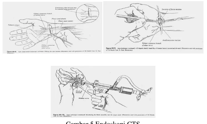 Gambar 5.Endoskopi CTS 