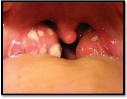 Gambar 5. Tonsilitis akut 