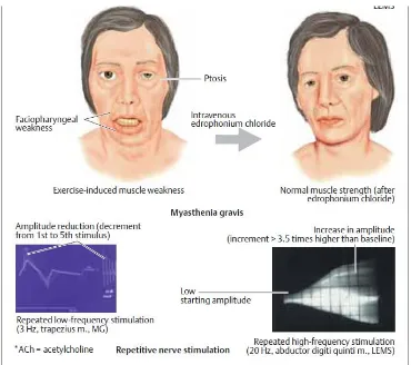 Gambar 3. Tes Edrophonium dan EMG pada myasthenia gravis 