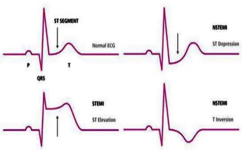 Gambar 2.9 Gambaran Cardiac Marker EKG pada penyakit jantung koroner   Sumber : www.isisc.or.id 