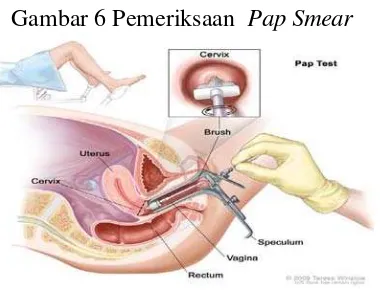 Gambar 6 Pemeriksaan  Pap Smear 