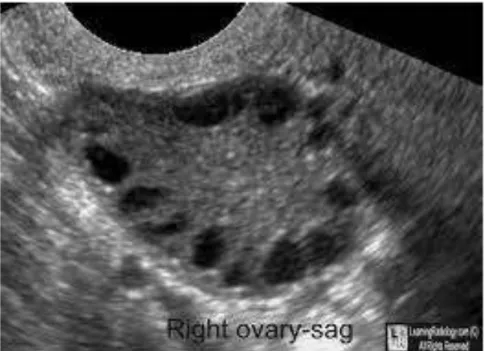 Gambar 2.6. Gambaran SOPK pada Ultrasonografi  Sumber : Learning Radiology 