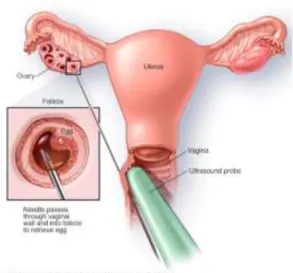 Gambar 2.9  IVF Procedure  Sumber : Mayo Clinic 