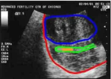 Gambar 2.10 Embryo Transfer pada IVF  Sumber : Advanced Fertility Center of Chicago 
