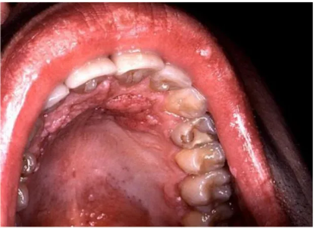 Gambar 5. Infeksi HPV pada rongga mulut. 