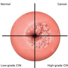 Gambar 4. Diagram tahap infeksi HPV pada serviks. 