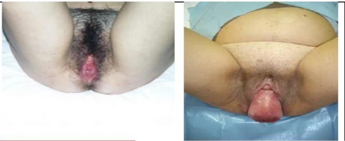 Gambar 2.2 kondisi prolaps uteri tingkat 1 dan 3 (Cunningham,2013). 