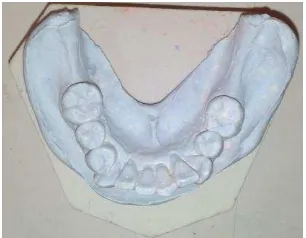 Gambar 1. Keadaan intraoral rahang atas dengan kondisi gigi 17 dan 27 telah mengalami ekstruksi bagian cusp mesio         palatal ± 2mm (A); dan rahang bawah dengan kehilangan gigi 37 dan 47 (Kennedy klas I) (B) 