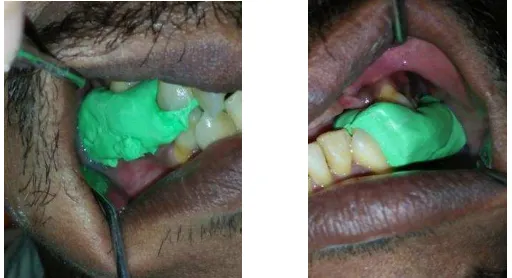 Gambar 5. (A) Mahkota sementara gigi 45, 46; (B) Mahkota sementara gigi 35, 36 