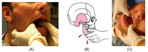 Gambar 5. Cara manual mengembalikan Sendi Temporomandibula yang mengalami dislokasi (A) (B) Posisi operator dari depan pasien