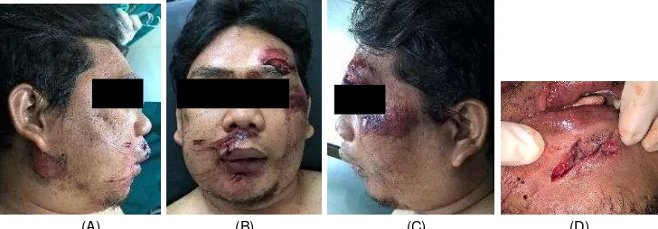 Gambar 1. Ekstra Oral tampak pembengkakan pada pipi kanan dan beberapa luka robek pada wajah 