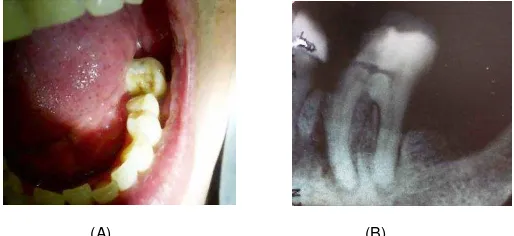 Gambar 1. Foto awal gigi 36. (A) Terlihat terdapat kavitas kelas 2 di bagian mesio oklusal gigi 36 (B) Foto rontgen awal, terlihat adanya kavitas di bagian mesial dengan kedalaman pulpa disertai pelebaran ligament periodontal pada ujung akar mesiobukal