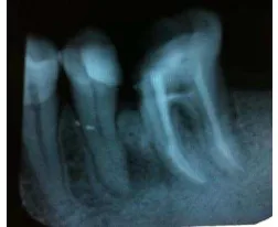 Gambar 3. (A) Foto radiograf pengepasan gutta perca F2 (B) Foto radiograf setelah dilakukan obturasi 