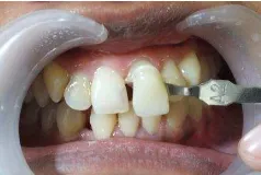 Gambar 1. Foto awal gigi 21. (A) Tampak ada bayangan hitam kecoklatan pada sisi mesio-insisal gigi 21
