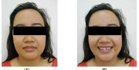 Gambar 1. Fotografi ekstraoral pasien sebelum perawatan (A) Tampak depan (B) Tampak depan tersenyum, terlihat gigi 21 tidak erupsi dan garis tegah rahang atas bergeser ke kiri 